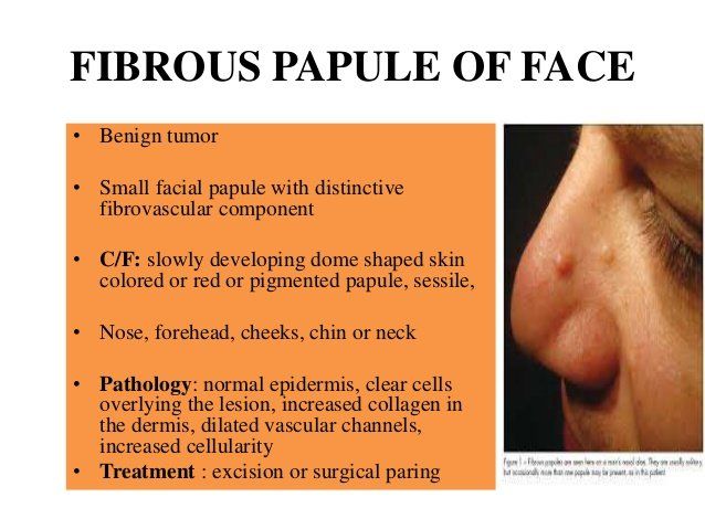 Treatment for fibrous papules facial angiofibroma