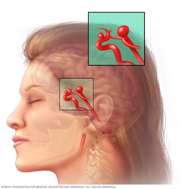 Cali reccomend Headache aneurism facial pain