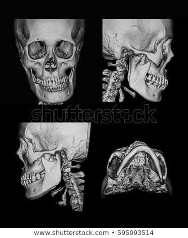 Ct scan facial bones