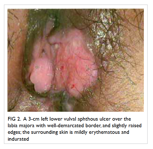 best of Vulva sore Female