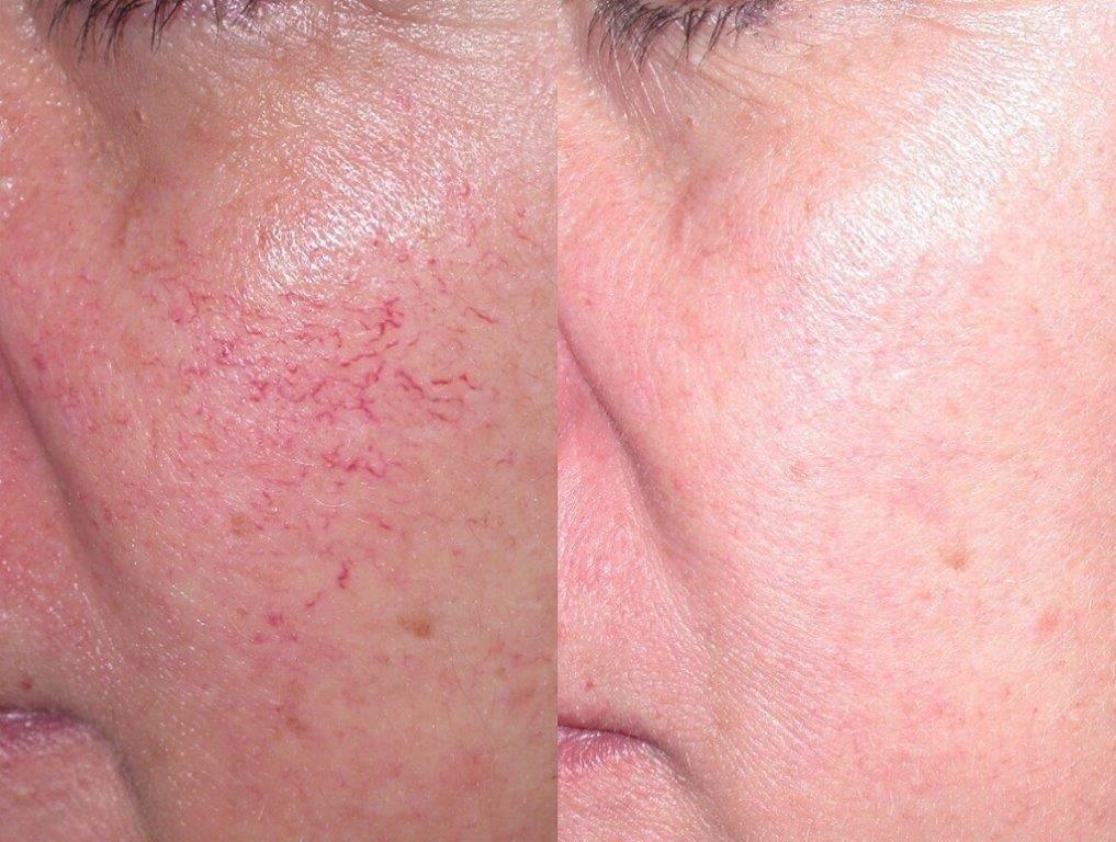 best of Facial Treatments for spider veins