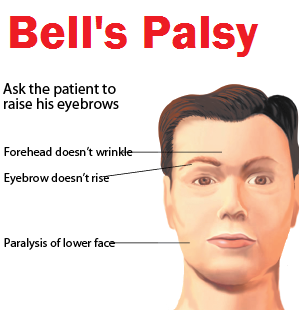 Half facial paralysis - Nude gallery