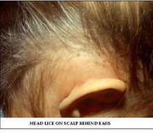 best of Lice on adults Head