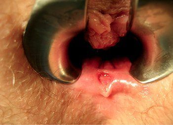 Picture of acute anal fissure ulcer