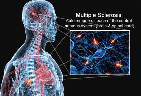 Multiple sclerosis painful sex