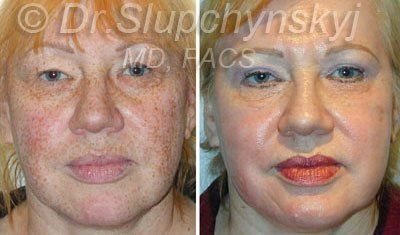 best of Facial home at step peeling Three