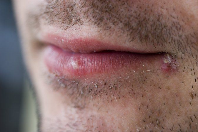 best of Herpes Cause facial