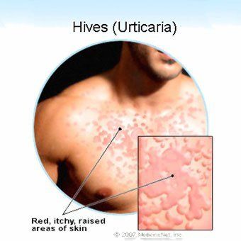 Causes of facial hives