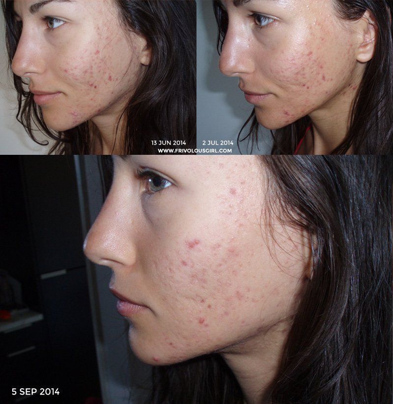 Bubbles reccomend Zinc oxide ointment for facial scar
