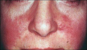 Facial red scaly dry skin
