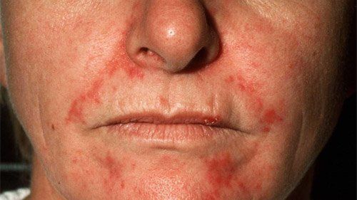 Rellie J. reccomend Recurring facial rash