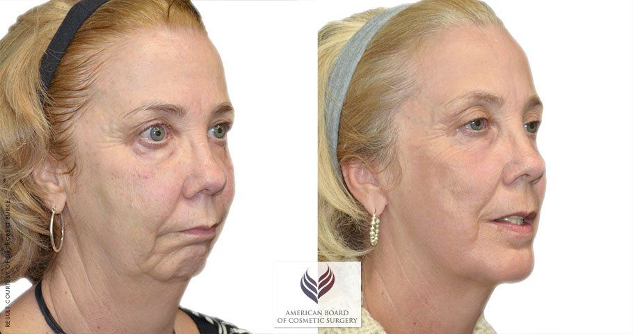 Stretch reccomend Complete lift facial cosmetic