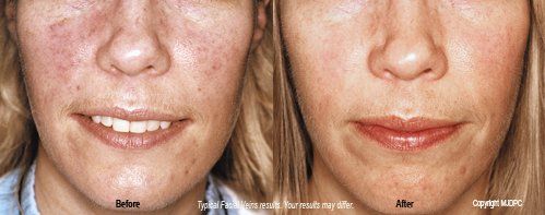 Treatments for spider veins facial
