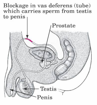 Vas deferens sperm blockage