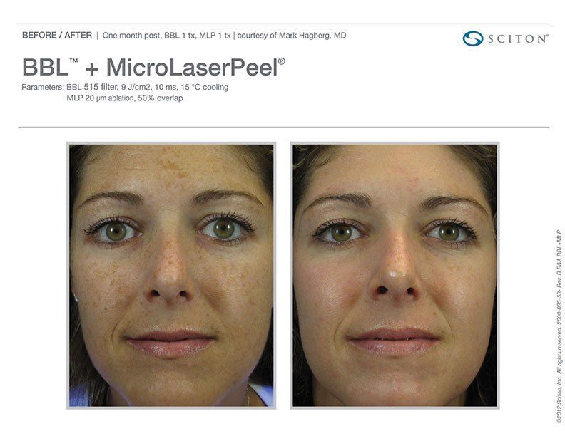 Lord P. S. reccomend Facial jersey laser new rejuvenation