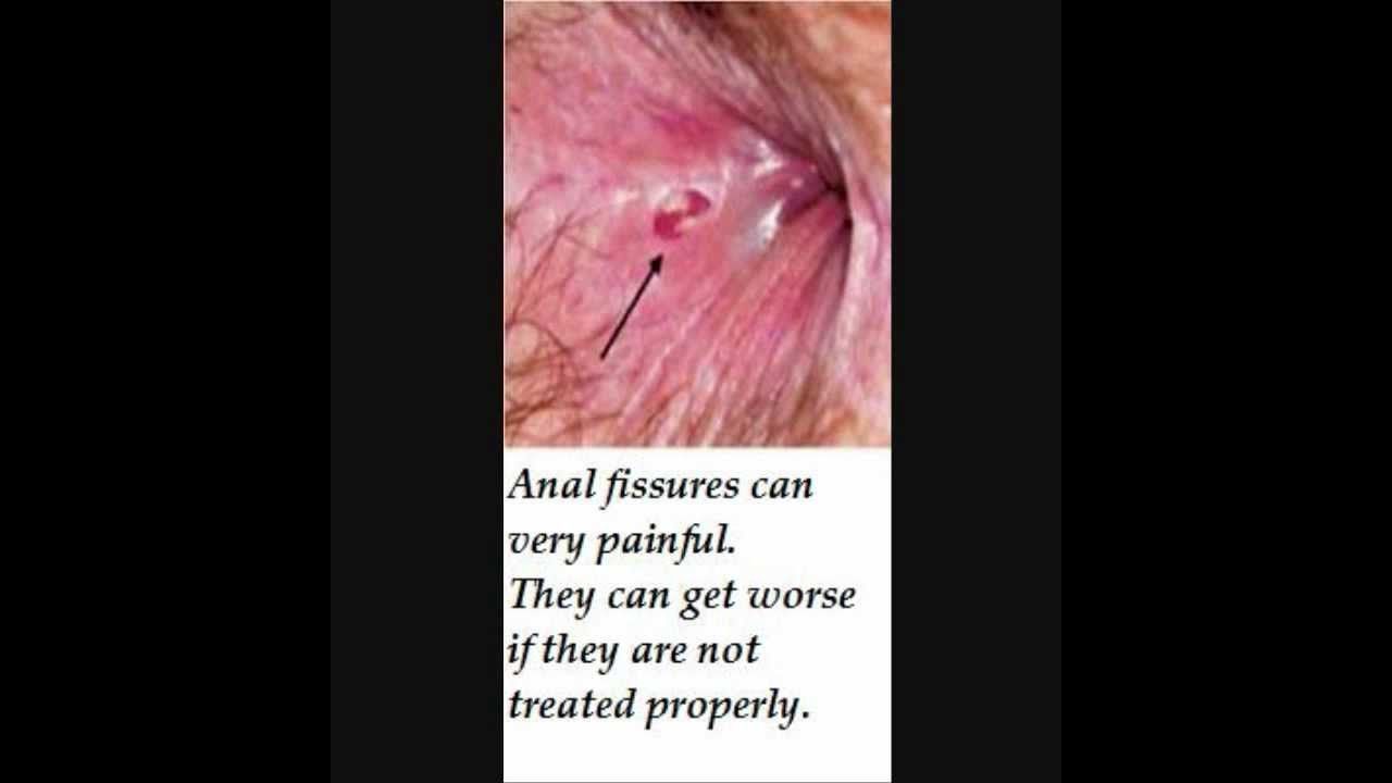 Picture of acute anal fissure ulcer