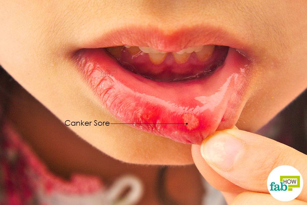 Asian canker sores