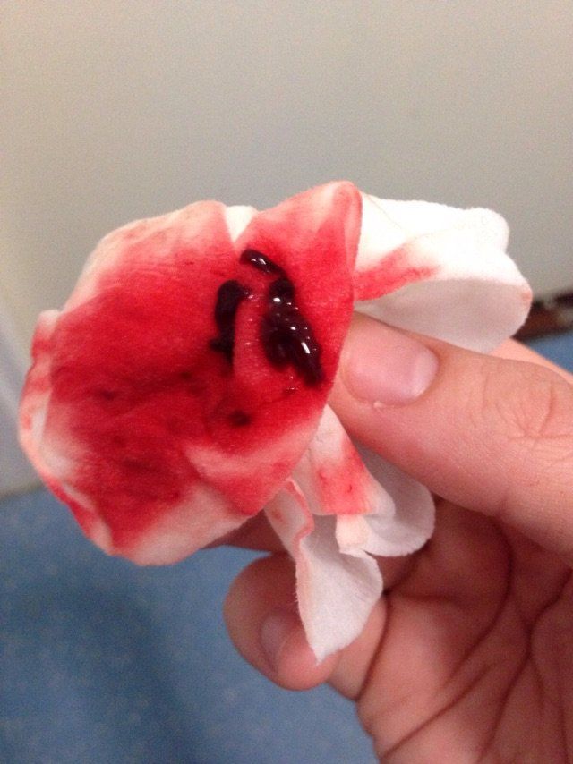 Radar reccomend Blood clots coming out of vagina