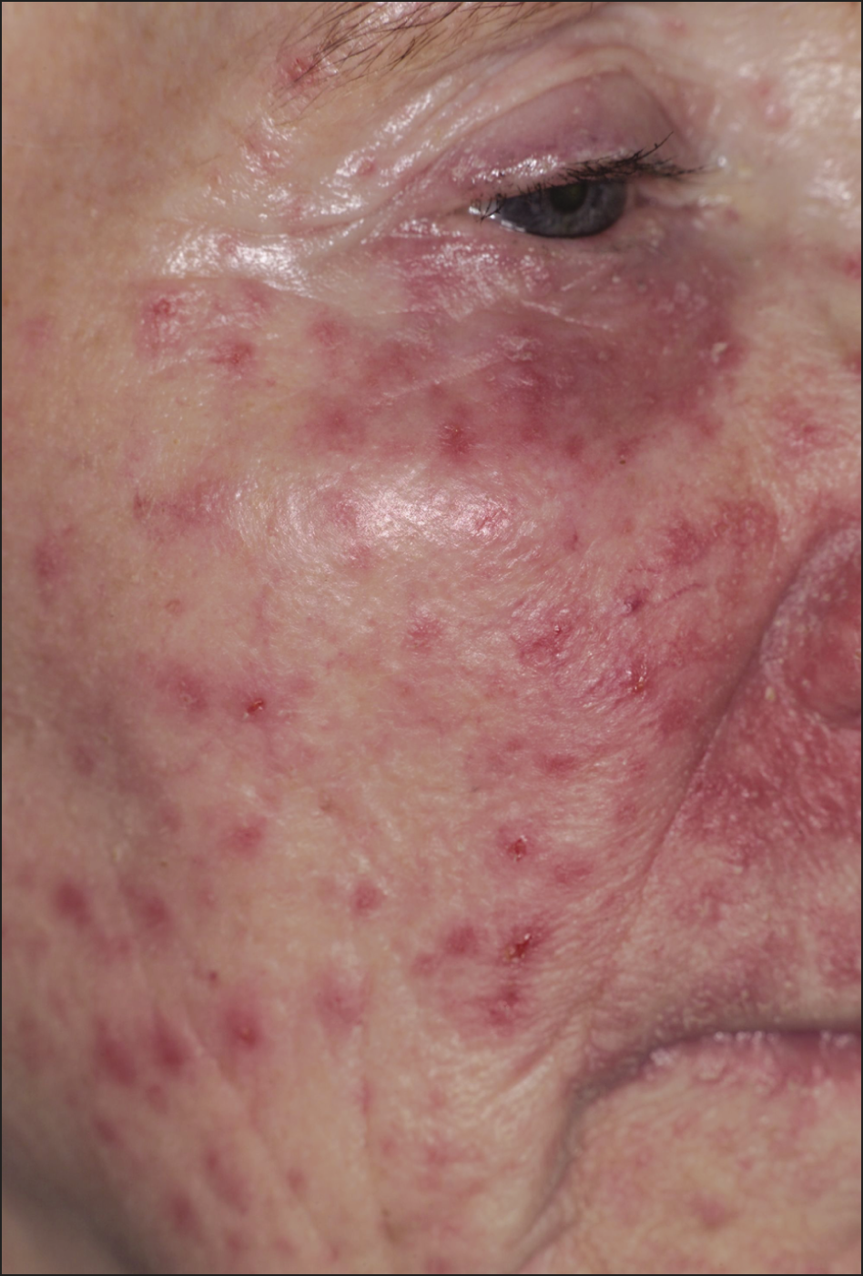 Candida albicans and facial dermatitis