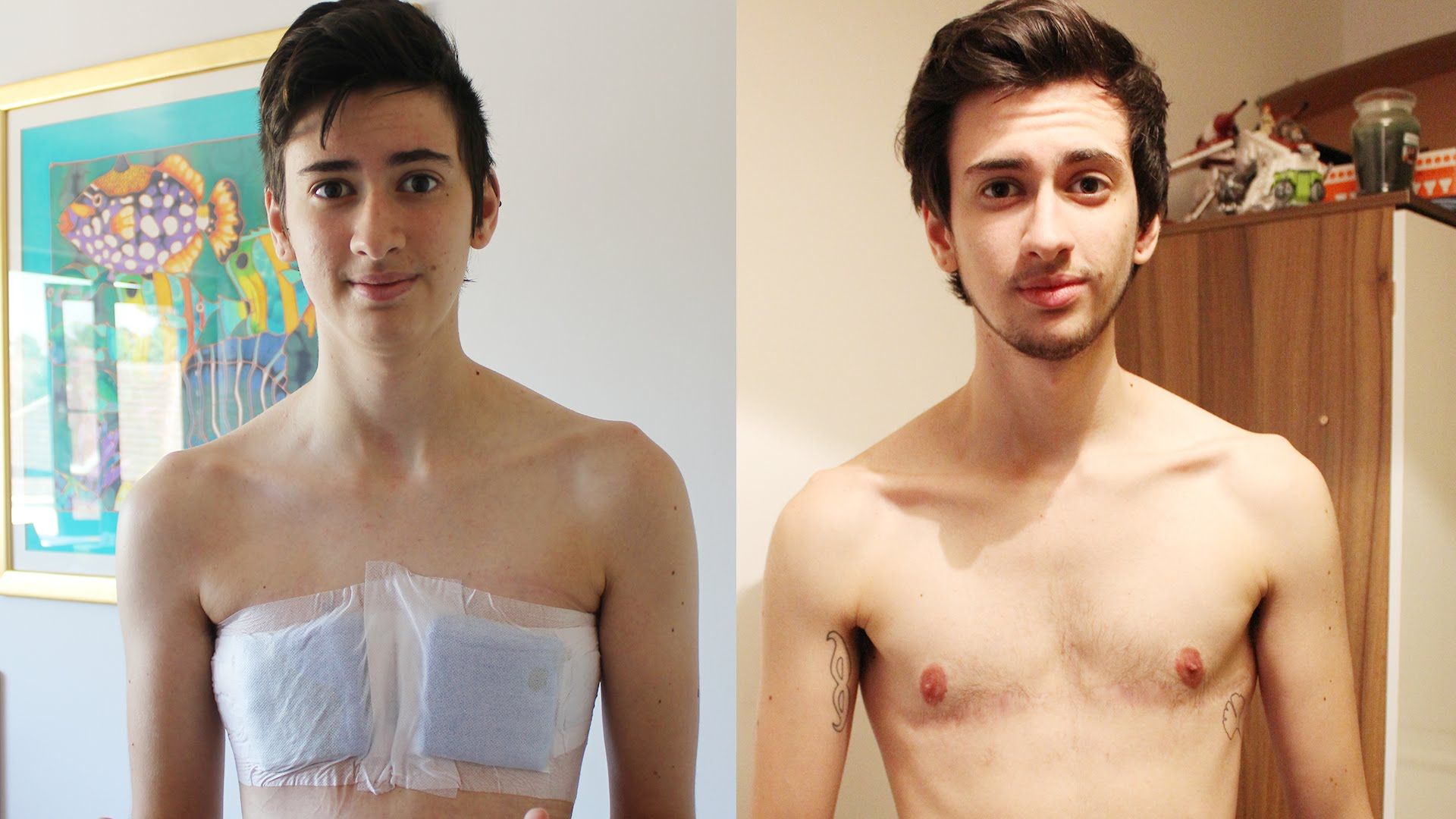 Ghost reccomend Gender picture reassignment surgery transsexual