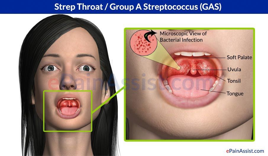 best of Ear infection strep Adult