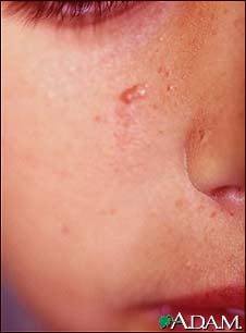best of Facial fibrous papules angiofibroma for Treatment