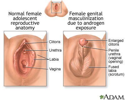 Congenital absence of vagina