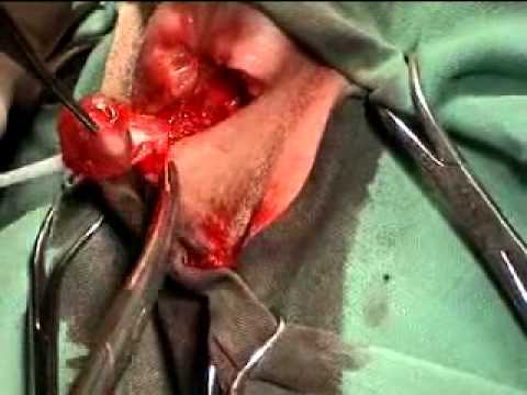 best of Glands Removing anal