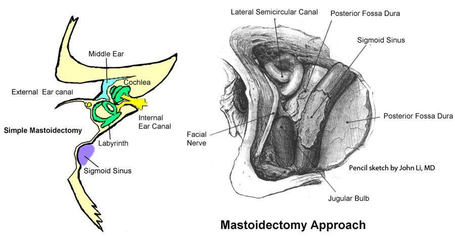 Mushroom reccomend Facial nerve mastoid