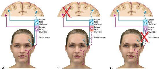 Facial 7 of paralysis after stroke