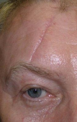 Hydraulics reccomend Facial laceration scar fading