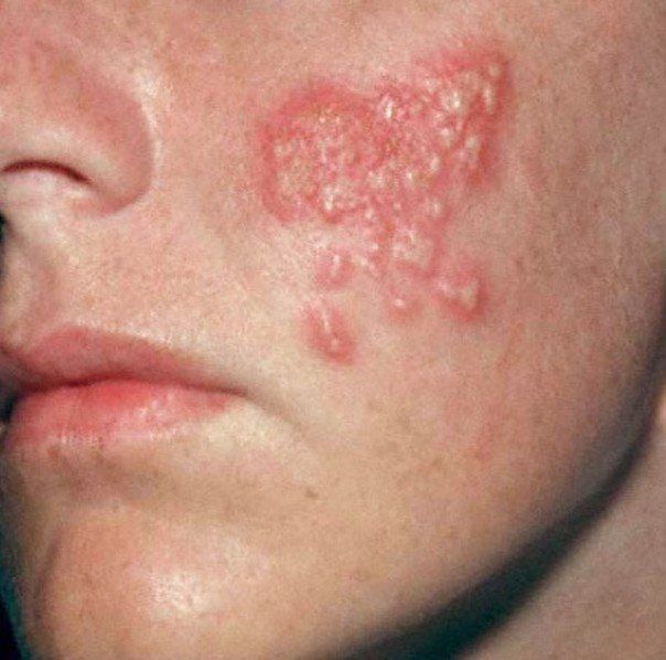 Recurring facial rash