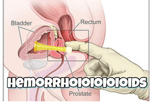 Pop R. reccomend Prostate makes anus raw