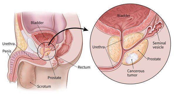 Infiniti reccomend Swollen anus prostate