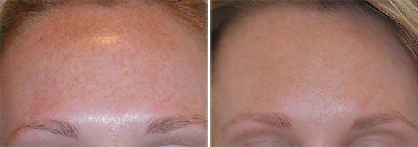 best of In women hair treatments Facial