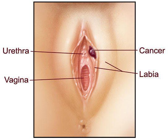 A bump in vagina area