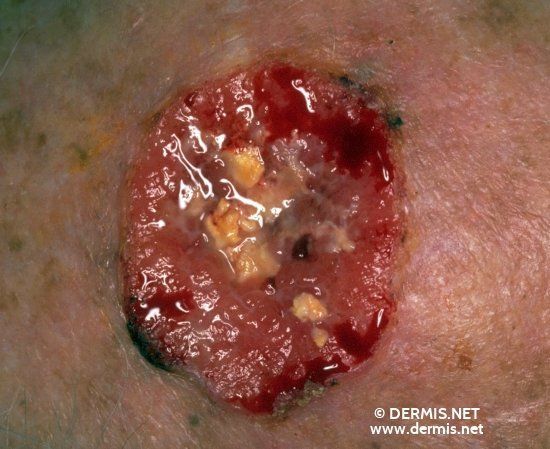 Anus carcinoma cell squamous