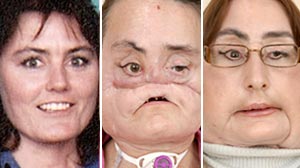 best of First transplant Facial picture