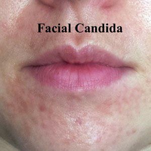 best of Facial and dermatitis albicans Candida