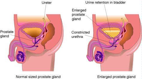 best of Prostate Swollen anus