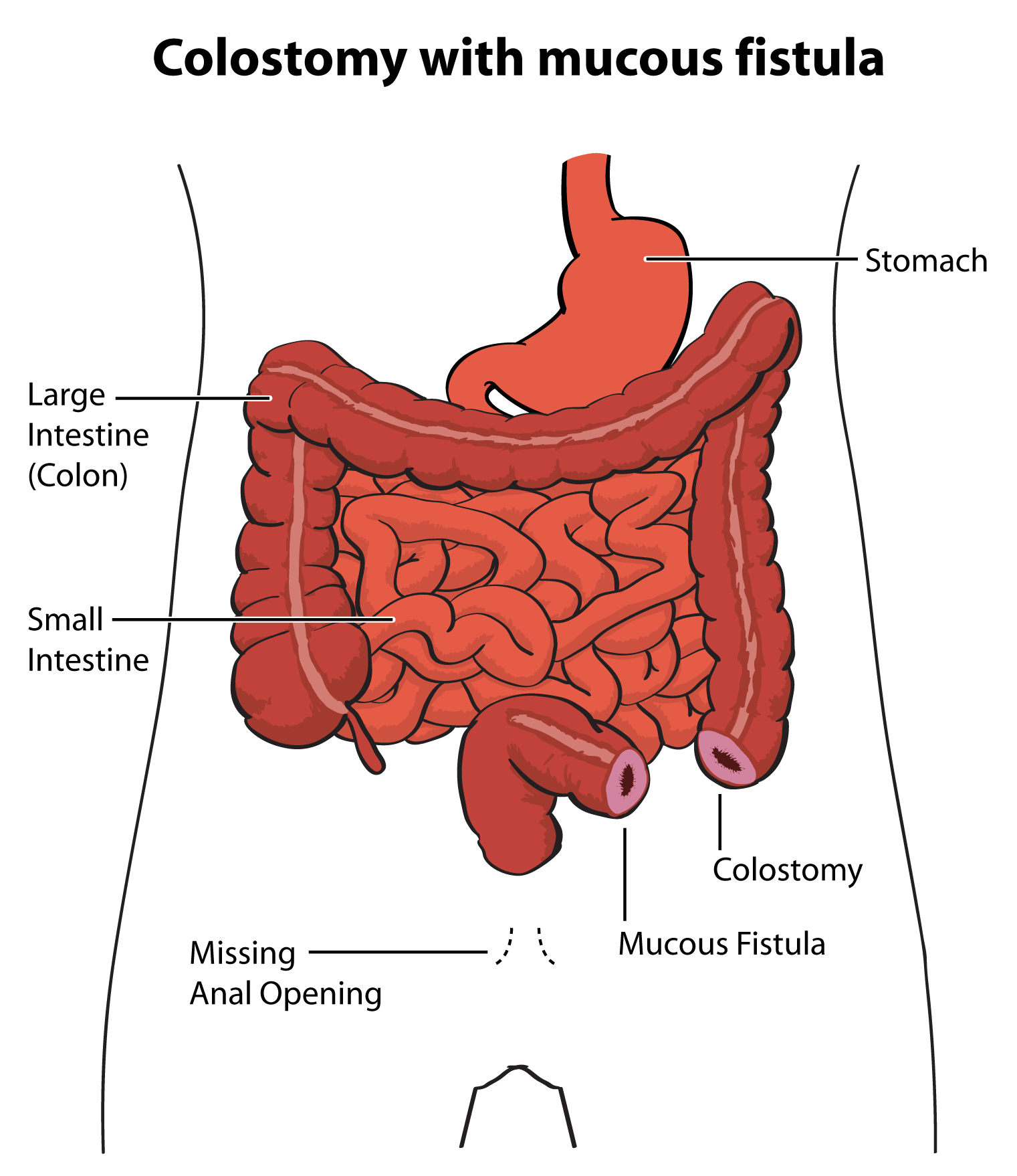 Excess anal mucus
