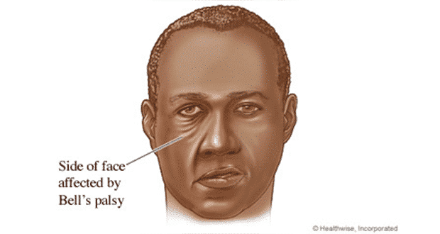 Facial 7 of paralysis after stroke