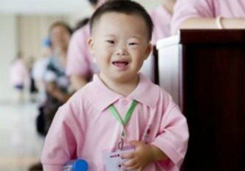 Facial characteristics chinese downs syndrome