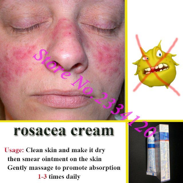 Sinker reccomend Facial cream to help rosacea