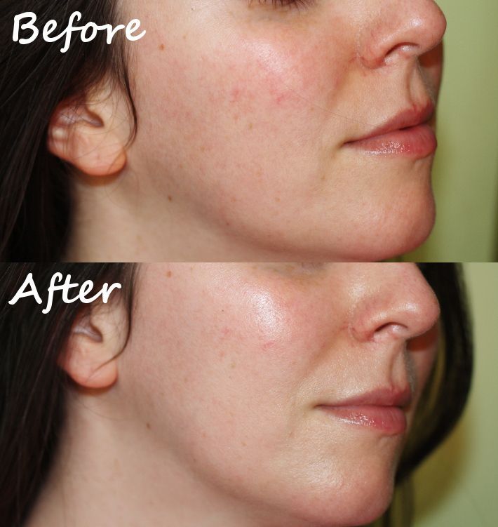 best of Rosacea Facial cream to help