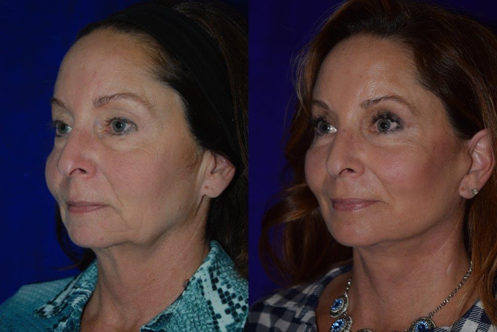 C-Brown reccomend Facial plastic sonoma surgery