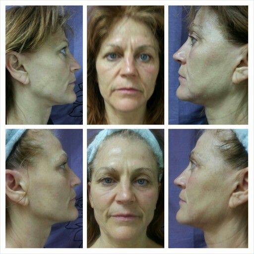 High frequency facial instructions