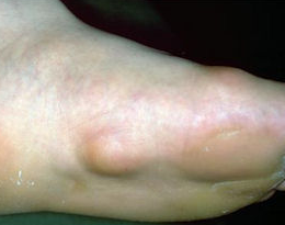 Itchy welt bottom of foot