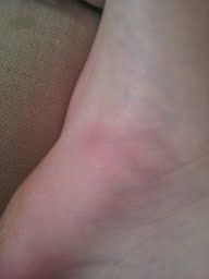 BBQ reccomend Itchy welt bottom of foot