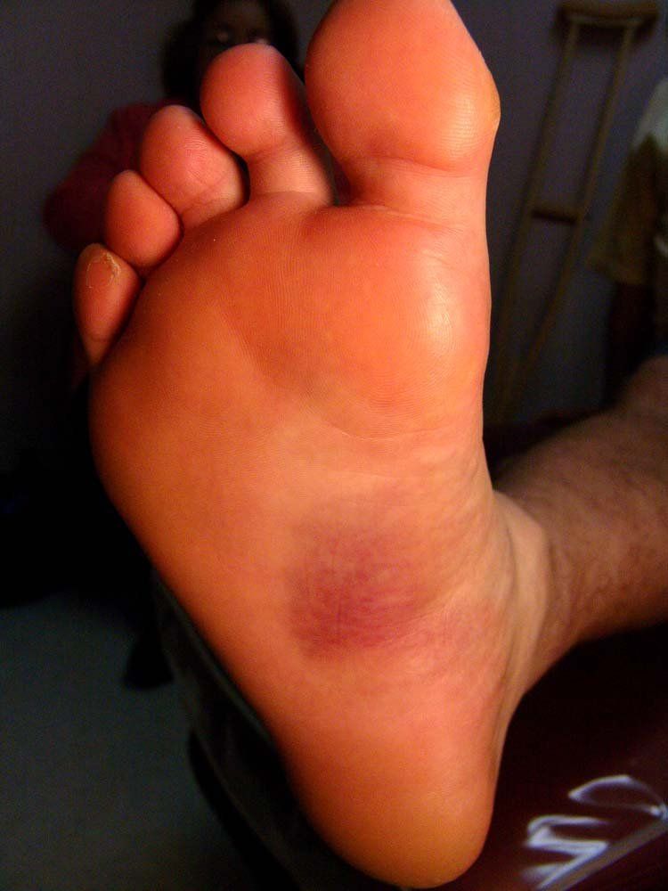 best of Foot Itchy welt bottom of
